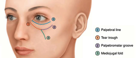 Tear trough target locations diagram